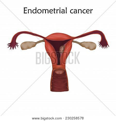 Endometrial Cancer. Human Realistic Uterus. Anatomy Illustration. Colored Image, White Background. G