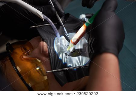 Closeup Of An Injection Made By A Doctor To A Patient With A Kofferdam