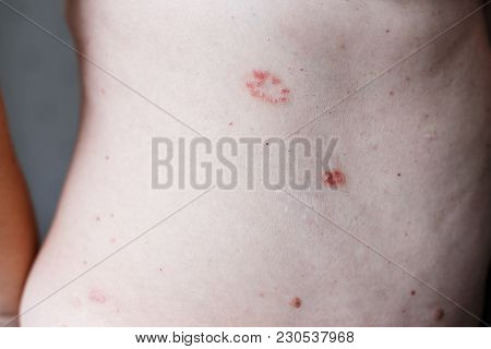 Psoriasis Skin. Psoriasis Is An Autoimmune Disease That Affects The Skin Cause Skin Inflammation Red