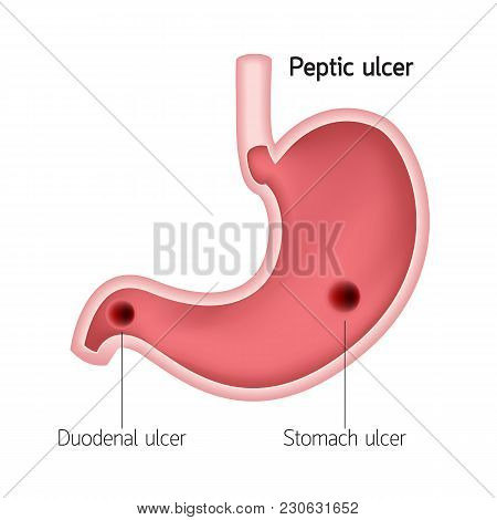Cross Section Of Human Stomach. Peptic Ulcer, Human Heath Care. Vector Illustration Isolated On Whit
