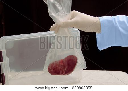 Kidney Transplant Surgery. Illegal Transplantation. Human Cadaver, Donor Organ In Hands Of Surgeon.
