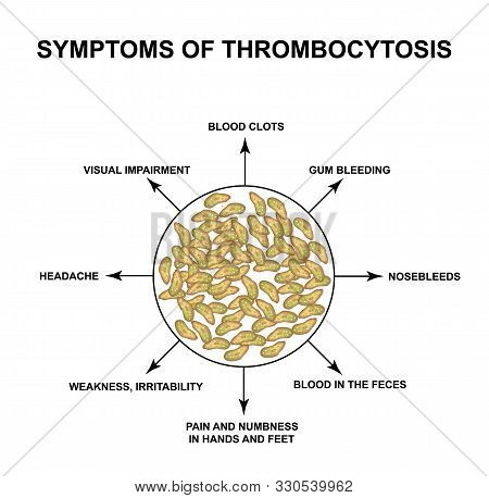 Symptoms Of Thrombocytosis. An Increase In Platelets In The Blood. Infographics. Illustration On Iso