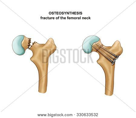 Illustration Of The Fracture Of The Femoral Neck. Osteosynthesis