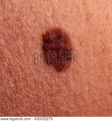Large Mole On Human Skin. Mole Removal Concept. Close-up, Selective Focus