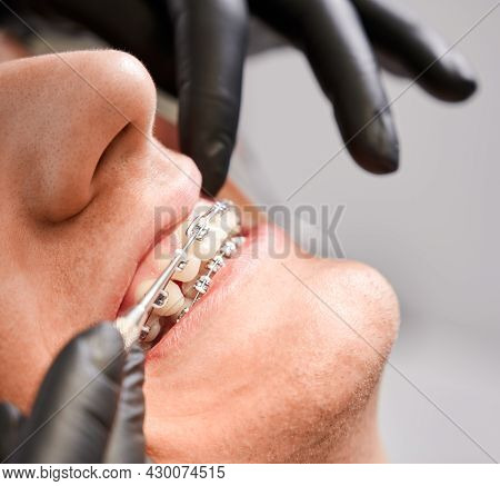 Close Up Of Orthodontist Hands In Sterile Gloves Putting Elastic Rubber Band On Patient Brackets In 