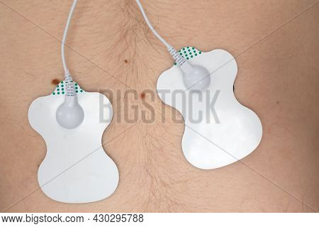 Ecg Electrodes On The Patient. Ecg Sensors For Electrocardiography
