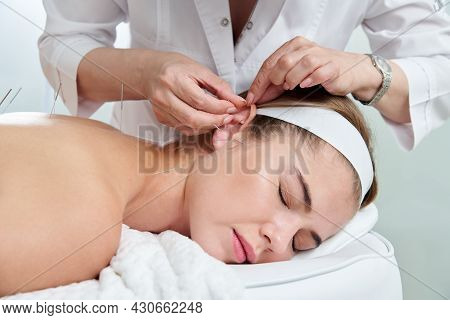 Beautiful Woman Relaxing On A Bed Having Acupuncture Treatment With Needles In And Around Her Ear. A