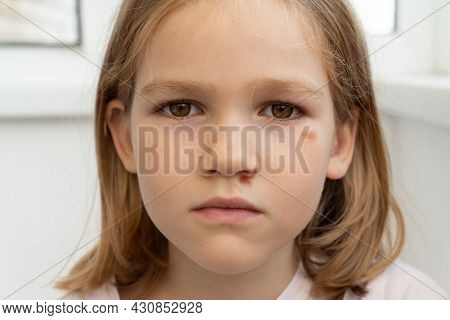 Portrait Girl With An Abrasion Under Her Eye. Child Abuse. Wounds And Abrasions