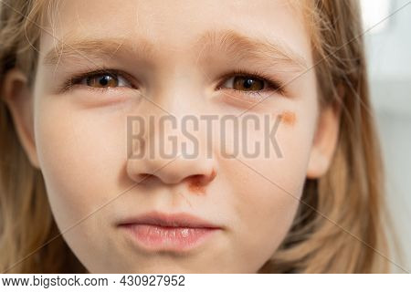 Portrait Girl With An Abrasion Under Her Eye. Child Abuse. Wounds And Abrasions