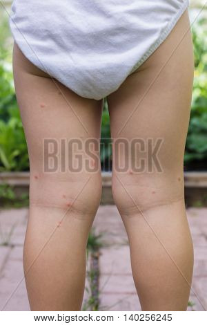 Bitten by mosquitoes legs of white  child