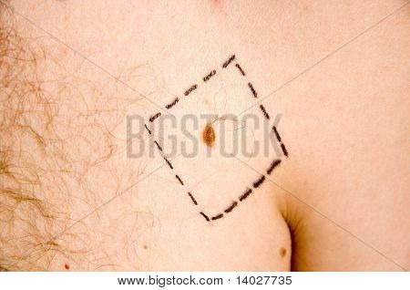 melanom s chirurgie nakreslený řádky