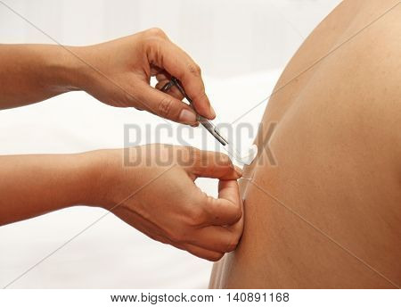 man in an acupuncture therapy j k