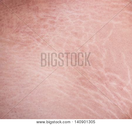 Stretch Marks Of Skin On The Thigh