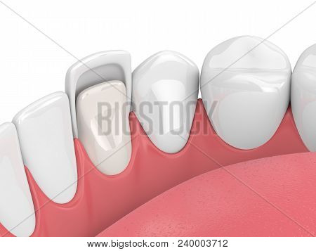 3D Render Of Teeth With Veneer