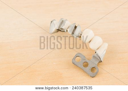 Damaged Dental Cermet Bridge Prosthesis On A Lamellar Implant
