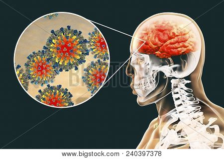 Measles-induced Encephalitis, Medical Concept, 3d Illustration Showing Brain Infection And Close-up 