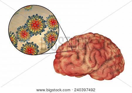 Measles-induced Encephalitis, Medical Concept, 3d Illustration Showing Brain Infection And Close-up 