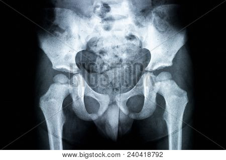 X-ray Of Pelvis And Spinal Column. X-ray Image Concept.