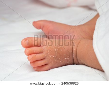 Closeup Instep Or Foot Of A Newborn With A Skin Peeling On White Cloth. Skin Allergies In Newborn Ca