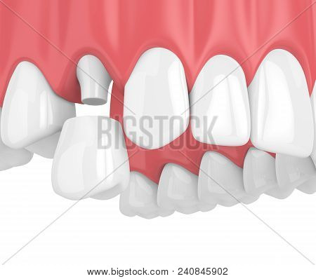 3D Render Of Upper Jaw With Teeth And Dental Premolar Crown
