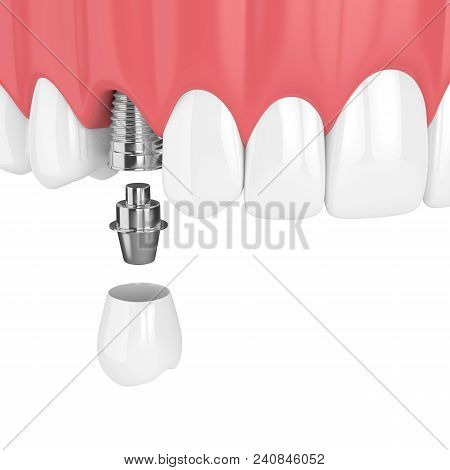 3D Render Of Upper Jaw With Teeth And Dental Premolar Implant