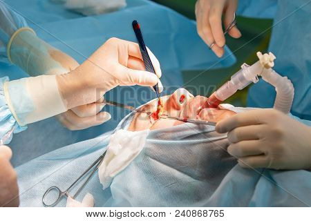 Plastic Surgery Of The Eyelid In Operating Room, Blepharoplasty