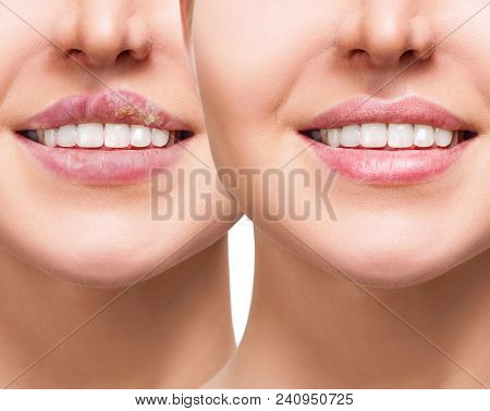 Collage Of Female Lips With Herpes Sore Before And After Treatment.