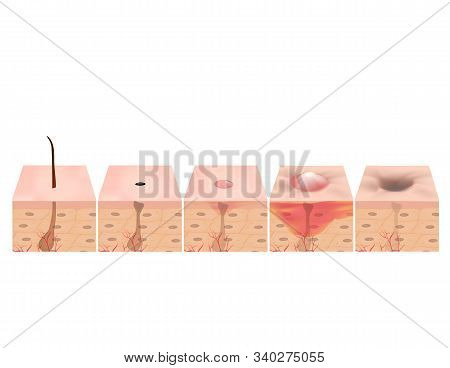 Treatment Of Open Comedones, Inflamed Acne, Acne Cysts. Sore Acne. Structure Of The Skin. Treatment 