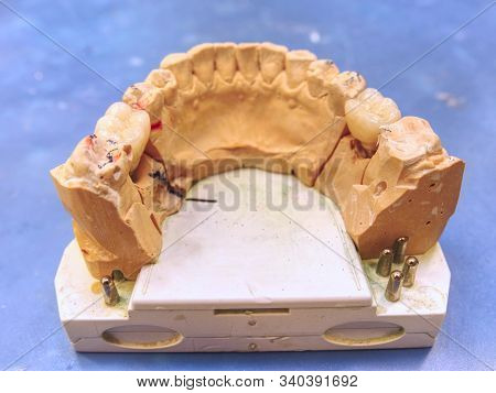 Metal Cast Pin Of Tooth On A 3d Model In Laboratory.  Sharpened  And Polished Tooth Model On Dental 