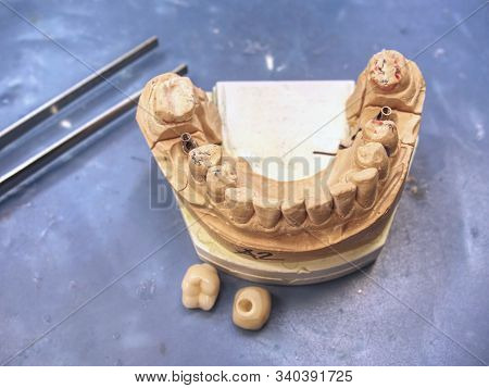 Metal Cast Pin Of Tooth On A 3d Model In Laboratory.  Sharpened  And Polished Tooth Model On Dental 