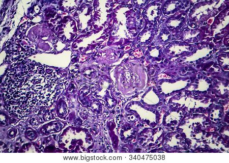 Chronic Nephritis, Light Micrograph, Photo Under Microscope