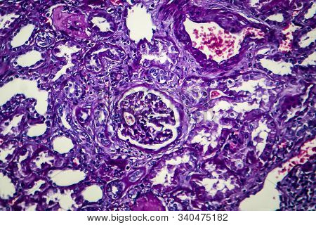 Chronic Nephritis, Light Micrograph, Photo Under Microscope