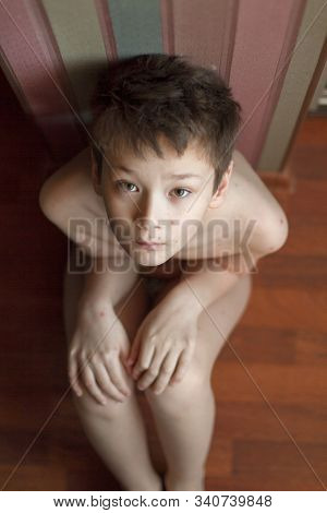 Poor boy with chickenpox. Sad little boy itching the body. Chickenpox rash