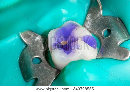 Restoration Of Tooth With Photopolymer Filling Close-up Macro. Caries