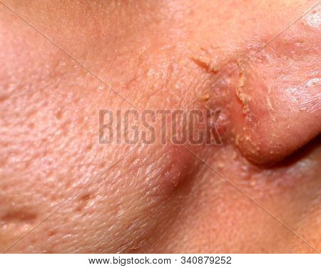 Inflamed Skin On The Face. Acne. Pimples On The Skin. Scars And Peeling.