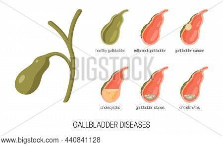 Gall Bladder Diseases In Cartoon Style, Vector