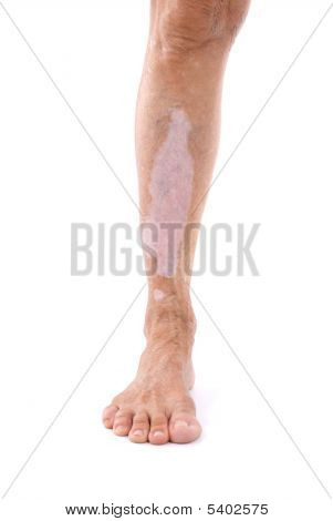 Vitiligo