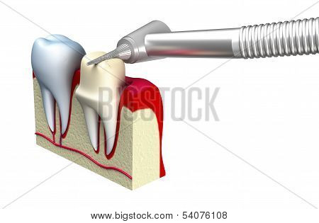 Dental crown installation process, isolated on white