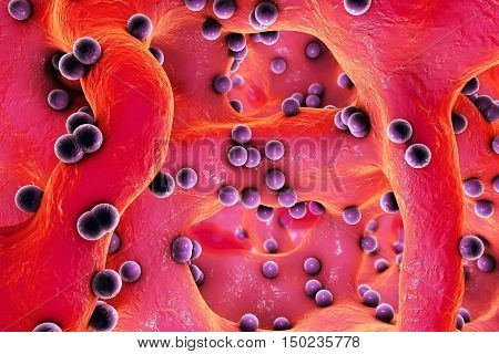 Spherical bacteria inside bone tissue. Osteomyelitis, 3D illustration
