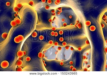 Spherical bacteria inside bone tissue. Osteomyelitis, 3D illustration