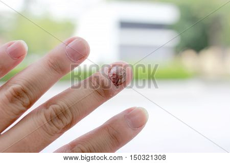Fungal Nail Infection And Damage On Human Hand. Finger With Onychomycosis