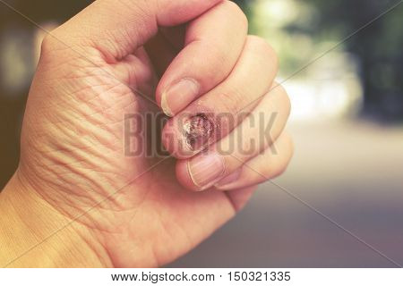 Fungal Nail Infection And Damage On Human Hand. Finger With Onychomycosis