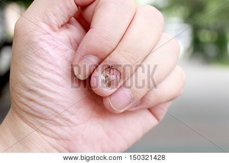 Fungal Nail Infection And Damage On Human Hand. Finger With Onychomycosis