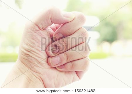Fungal Nail Infection And Damage On Human Hand. Finger With Onychomycosis