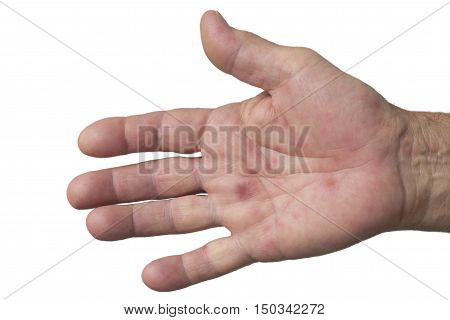 hand foot and mouth disease HFMD palm rash