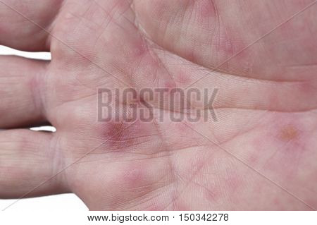 hand foot and mouth disease HFMD palm rash