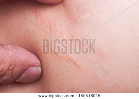 Closeup On Finger Embrace Stretch Marks Or Cellulite On Belly