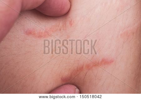 Closeup On Finger Embrace Stretch Marks Or Cellulite On Belly