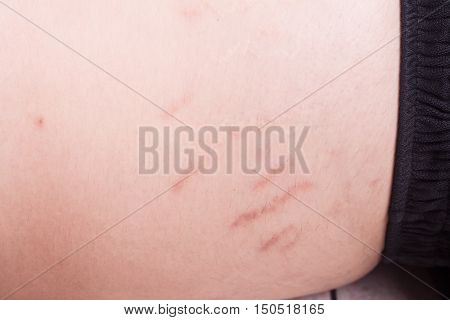 Closeup On Stretch Marks Or Cellulite On Waist Belly