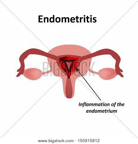Endometritis. Inflammation of the endometrium. Inflammation of the uterus. Infographics Vector illustration on isolated background.